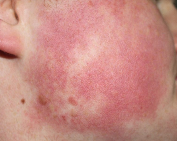 Pilarna keratoza ("kurja koža") Kako jo pravilno negovati? DK Glowy