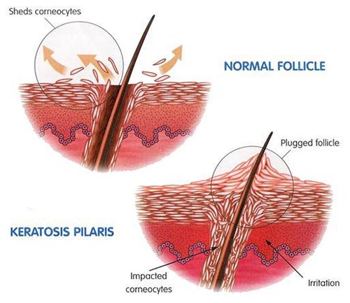 diagram pilarne ketoze