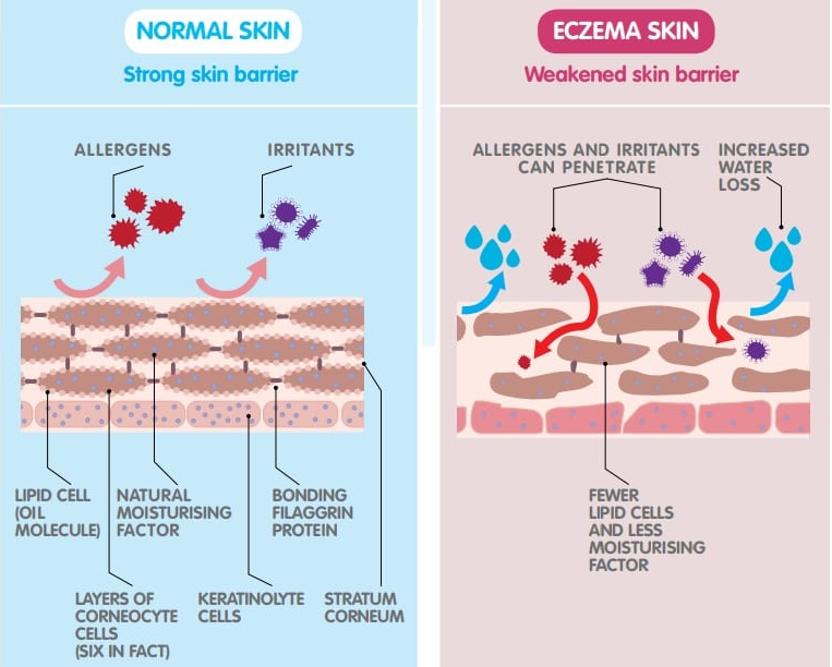 Can Essential Oils Help Eczema and Atopic Dermatitis?