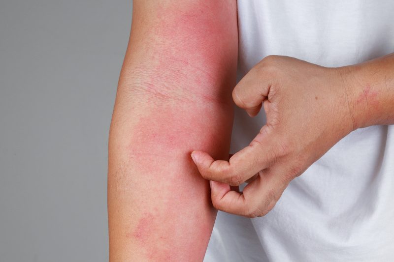 psoriaza na roki osebe