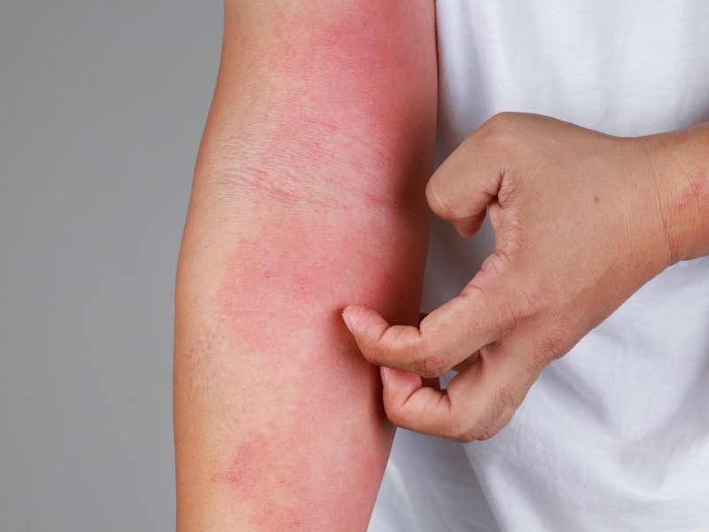 psoriaza na roki osebe
