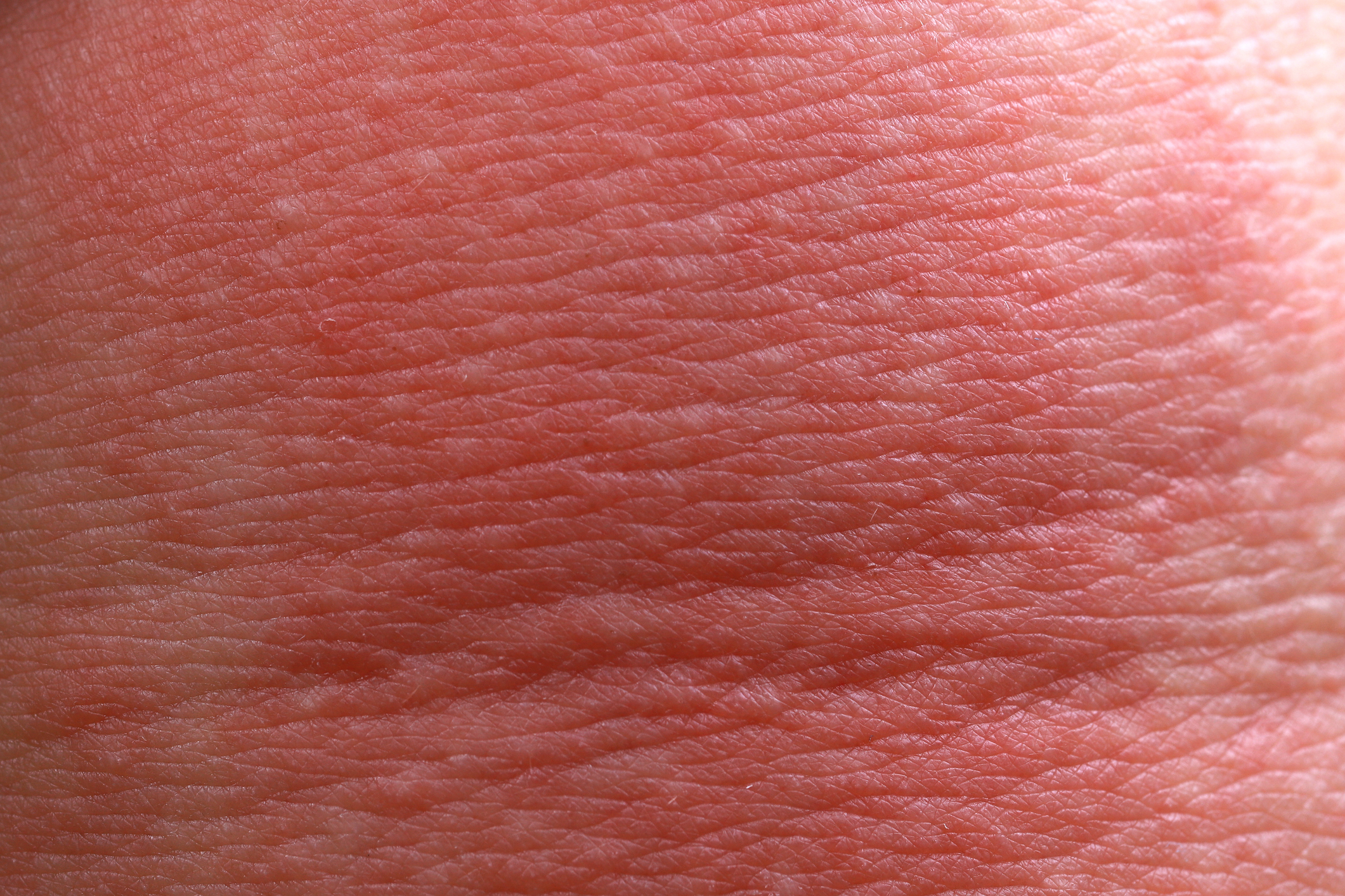 Celotna slika teksture bolnikove kože zaradi atopičnega ekcema