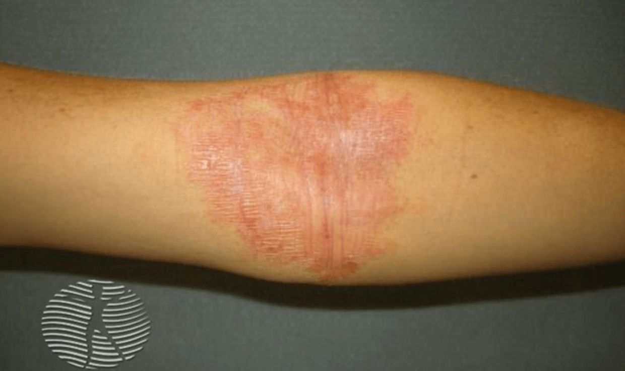 atopijski dermatitis primer 2