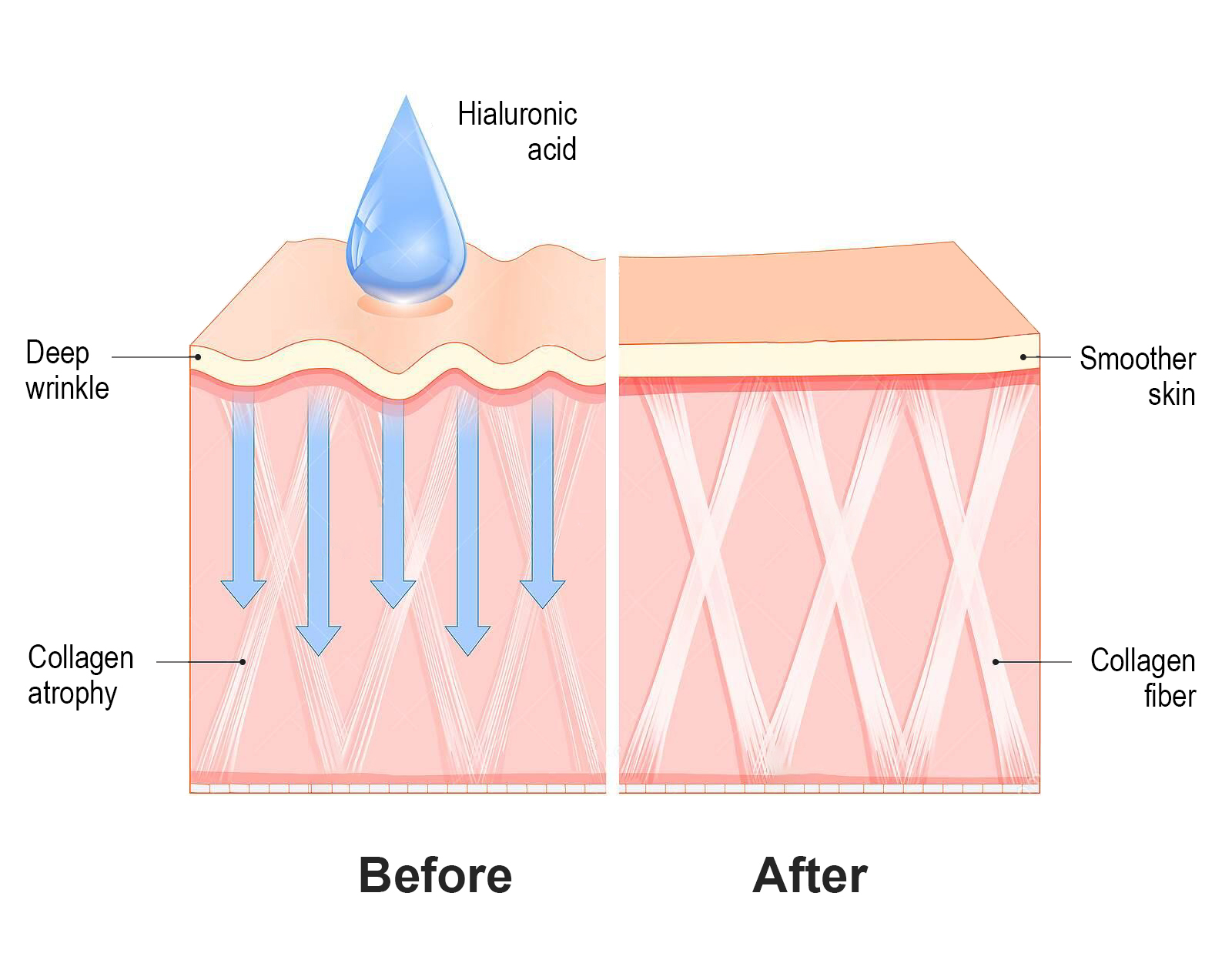 What Is Hyaluronic Acid And Why Is It In So Many Skincare Products 